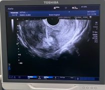 Ablação de miomas por ultrassom