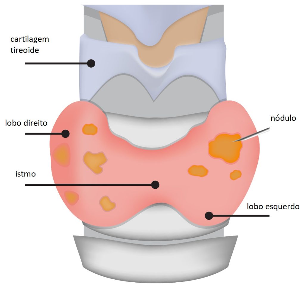 Nódulos de Tireoide