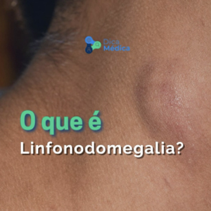 o que é linfonodomegalia