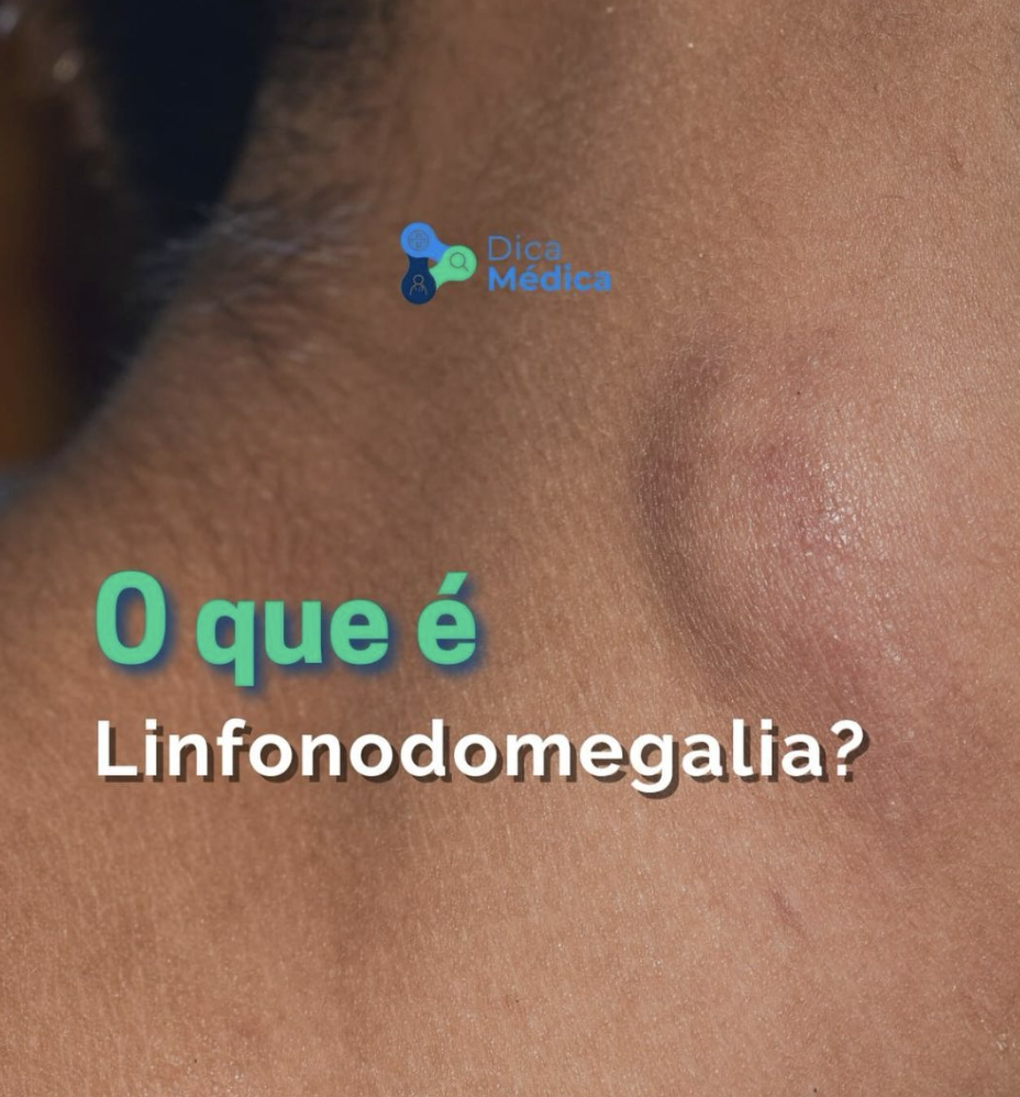 linfonodomegalia cervical