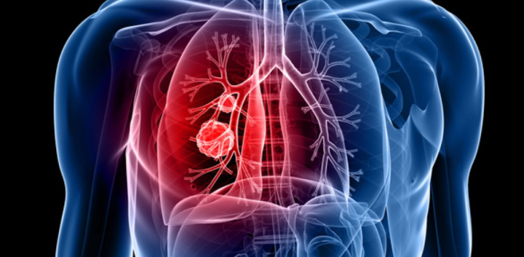 nódulos pulmonares