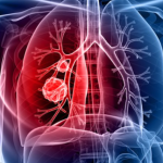 nódulos pulmonares