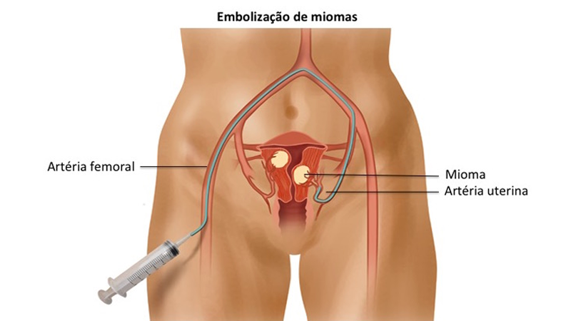 embolização de miomas uterinos