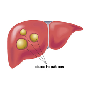 cistos hepáticos