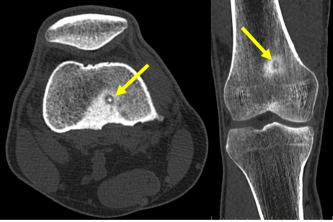 Abaulação de osteoma osteoide