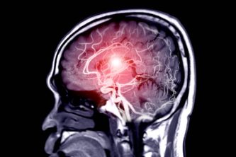 Fusion image of MRI and MRA Brain or Magnetic resonance angiography ( MRA )  of cerebral artery in the brain Sagittal view for evaluate them  stenosis  and stroke disease.