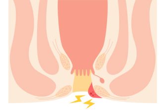 Diseases of the anus, hemorrhoids and warts "Thrombosed external hemorrhoids" Illustration, cross-sectional view