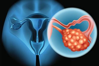 Ovarian cancer in human illustration