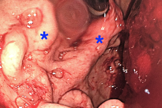 Endoscopia digestiva alta com vaso anômalo no estômago