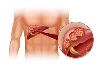 Escleroterapia de cistos hepáticos