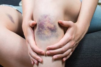 Close up image of female person sitting on sofa and holding in hands wounded leg with hematoma