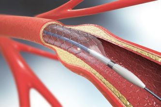 3d illustration of stent implantation for supporting blood circulation into blood vessels