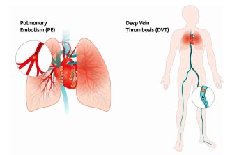 Tratamento de tromboembolismo pulmonar