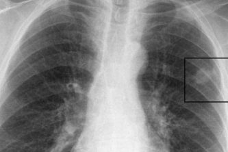 ablacao-de-metastase-pulmonar