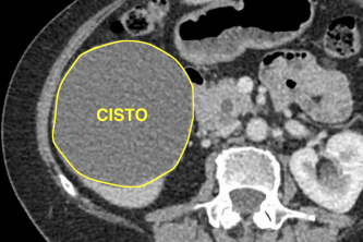 Cisto hepatico tomografia computadorizada