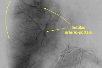 sindrome HELLP - fistula arterio-portal