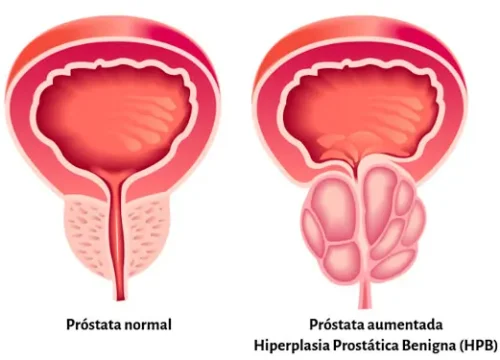 tratamento-HPB