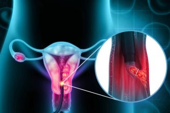 Dilation and curettage (d and c).endometrial biopsy.cervical cancer.3d illustration